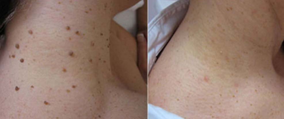 Hermsa® non-invasive laser pointer – mole and wart removal (🔥Last day of 50% discount)