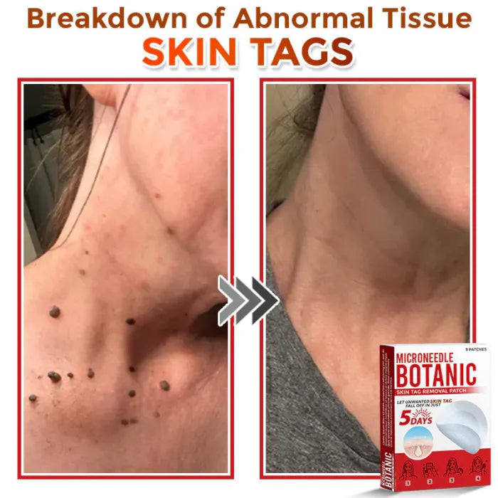 Painless Skin Tag & Wart Removal Patches