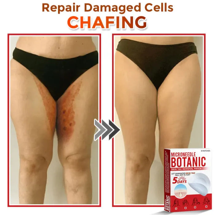 Painless Skin Tag & Wart Removal Patches