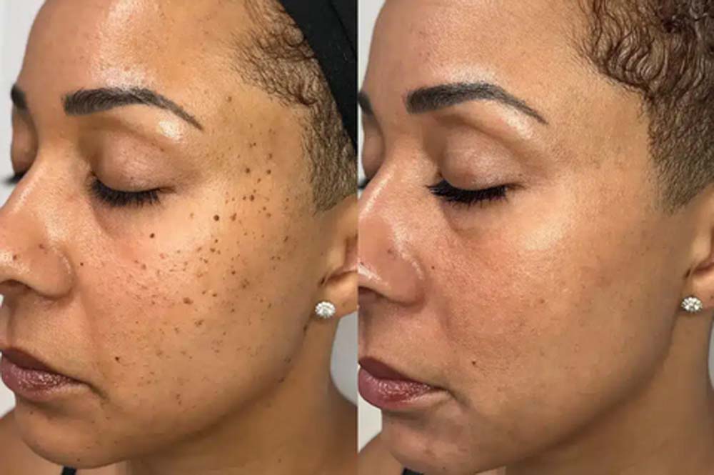 Hermsa® non-invasive laser pointer – mole and wart removal (🔥Last day of 50% discount)