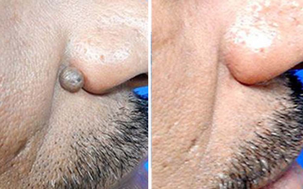 Hermsa® non-invasive laser pointer – mole and wart removal (🔥Last day of 50% discount)