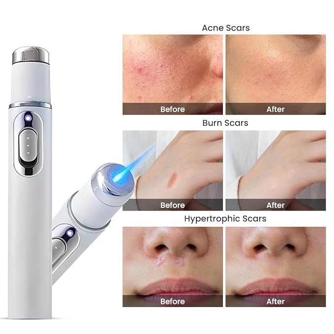 Hermsa® non-invasive laser pointer – mole and wart removal (🔥Last day of 50% discount)