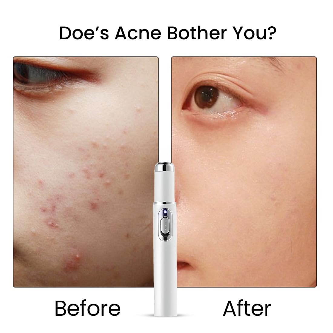 Hermsa® non-invasive laser pointer – mole and wart removal (🔥Last day of 50% discount)