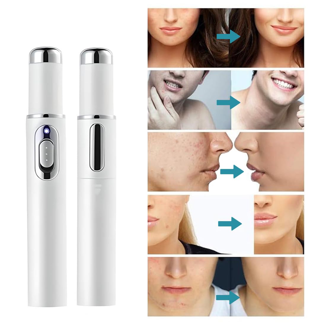 Hermsa® non-invasive laser pointer – mole and wart removal (🔥Last day of 50% discount)